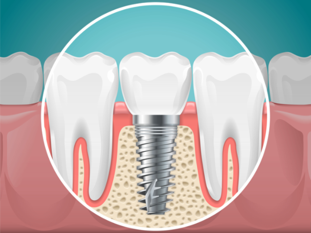 Artists impression of Dental implant screw in gum